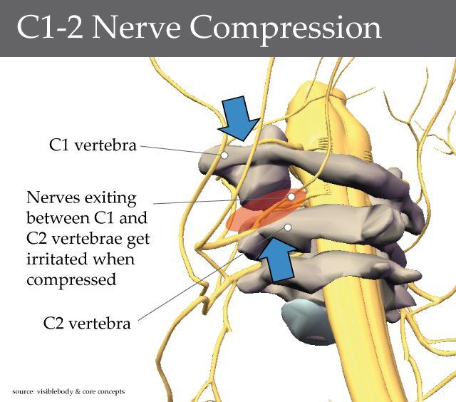 C1-2 Nerve Compression