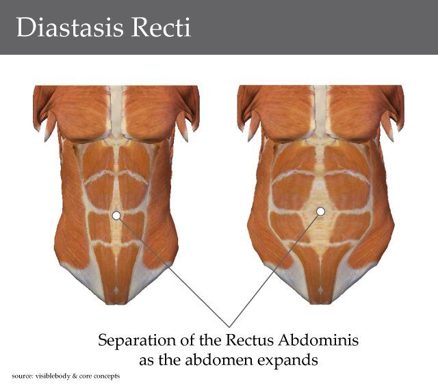 Diastasis Recti