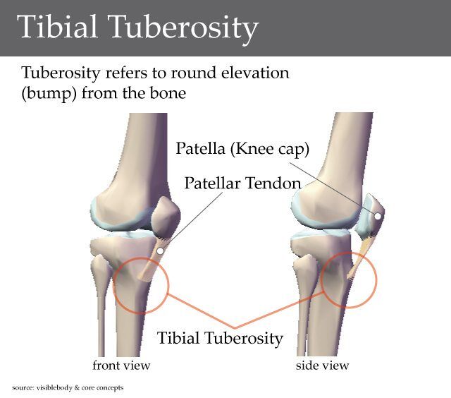 Osgood-Schlatter Disease