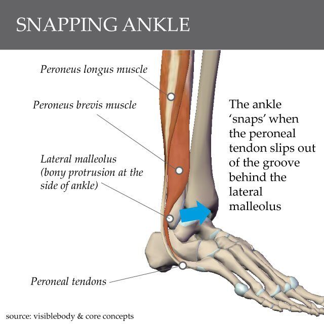Snapping Ankle