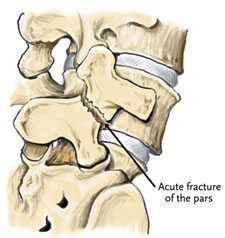 spondylosis