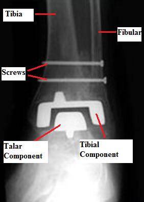 Ankle Replacement Surgery