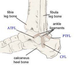 ankle sprain