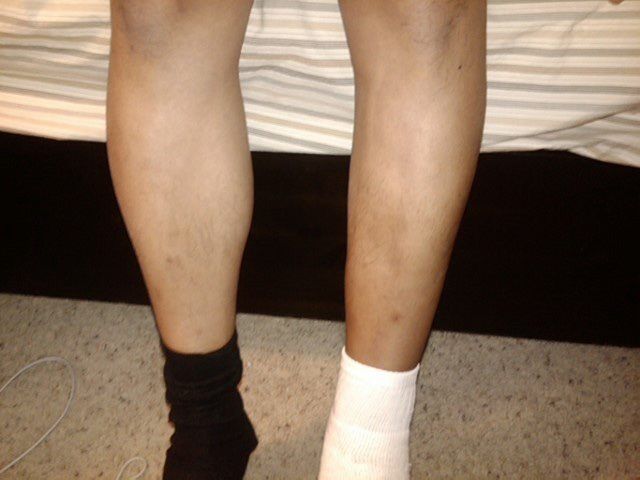 muscle atrophy