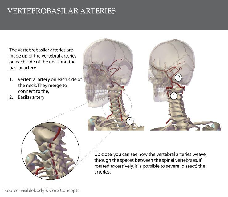 Vertebrobasilar Insufficiency