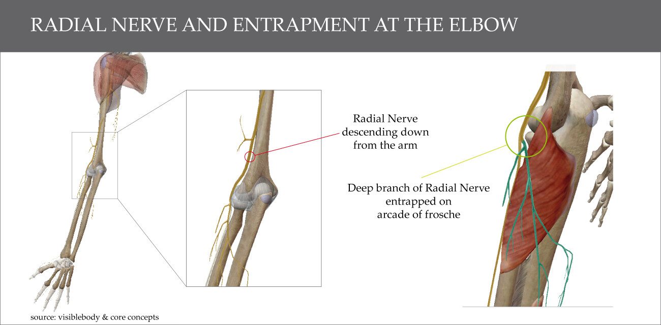 Entrapment of radial nerve in Radial Tunnel Syndrome