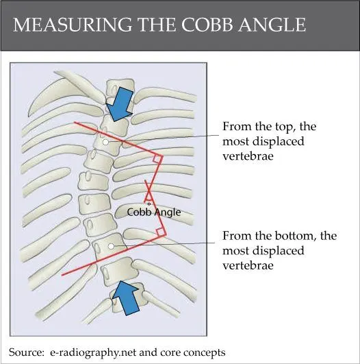 Measurement of Cobb Angle