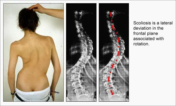 What is Scoliosis