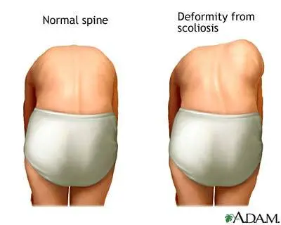Forward Bending Test for Scoliosis