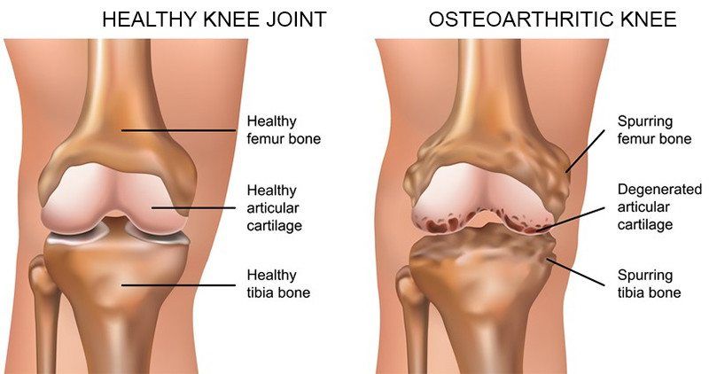 Comparison between a healthy knee, and osteoarthritic knee