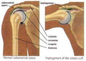 Shoulder Impingement Singapore