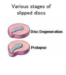 progression_slipped_disc1