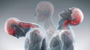 Whiplash Treatment Singapore movement of the head and injury areas during whiplash