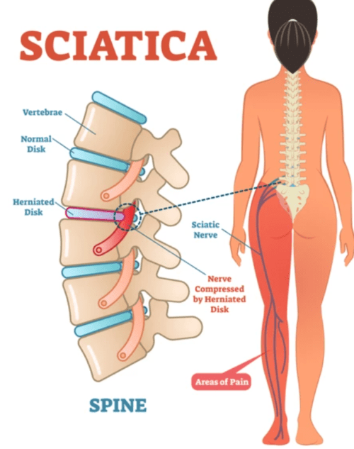 Sciatica  DISC Spine Institute TX