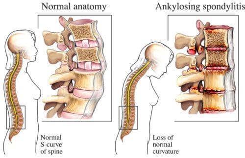 Spondylitis
