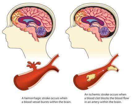 Types of Stroke