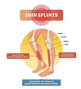 shin splints