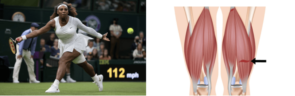 serena williams wimbledon injuries